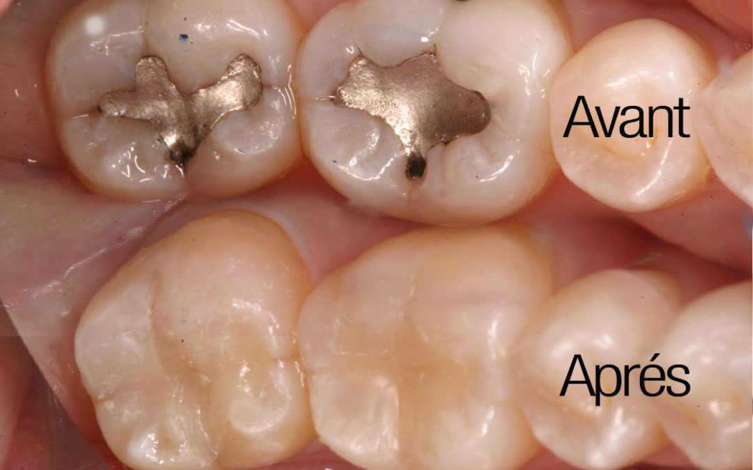 Plombages Dentaires : Inefficacité et Risques pour la Santé
