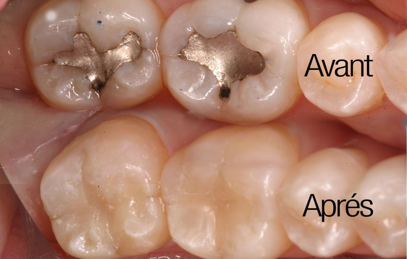 Les différents types de plombage - Clinique Dentaire Maizerets