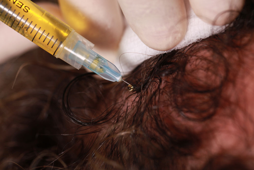 The bio-natural treatment of hair loss.