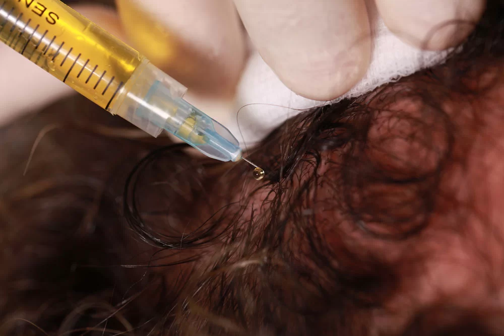 Le Plasma’Hair® : Une Révolution dans le Traitement de la Chute des Cheveux