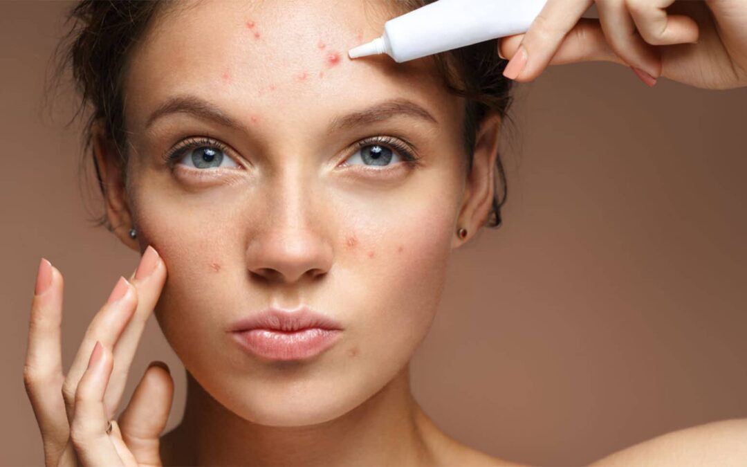 Acne: What are the causes and how to treat it in Mauritius?