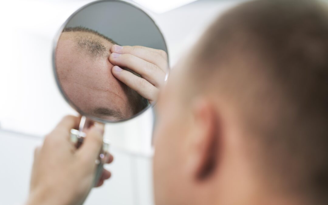 Calvitie : Comprendre les Causes et Découvrir les Traitements Disponibles