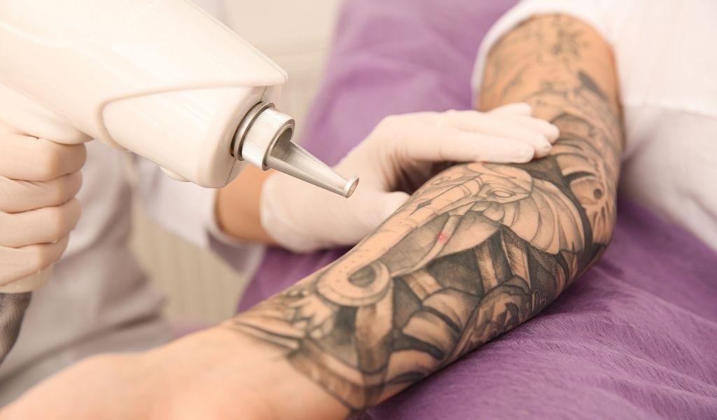 Détatouage à Maurice : Sûr, Efficace et Maintenant Plus Accessible que Jamais